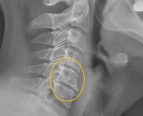 Gimdos kaklelio stuburo osteochondrozė