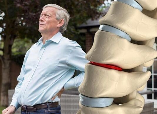 Osteochondrozė pažeidžia tarpslankstelinius diskus ir sukelia nugaros skausmus